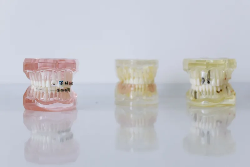 Clear Aligners or Metal Braces: How to Choose the Right Path to a Straighter Smile