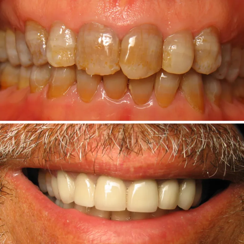 Month by Month: A Patient's Realistic Guide to a Complete Smile Makeover